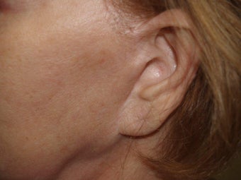 Scar and Earlobe Repair