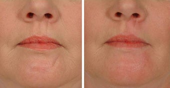 Restylane Scar Injection