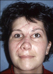 Facial Scar Improvement