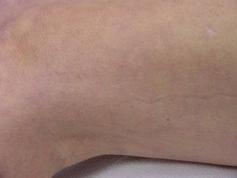 Sclerotherapy of spider veins
