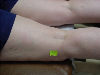 spider vein sclerotherapy