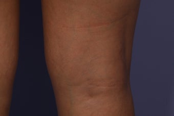 Sclerotherapy to Leg Veins