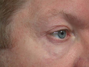 Sclerotherapy (eyelid)