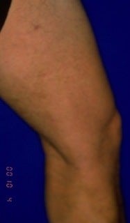 Sclerotherapy 