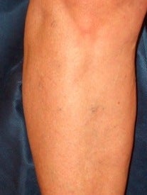 Sclerotherapy on Leg