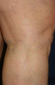 Leg Vein Sclerotherapy