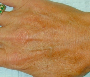 Sclerotherapy treatment for hand