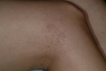 Sclerotherapy