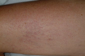 Sclerotherapy