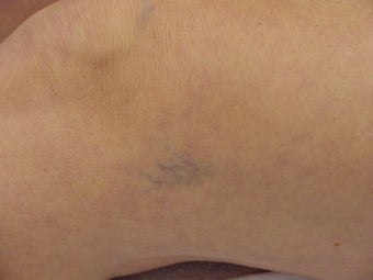 Sclerotherapy of spider veins