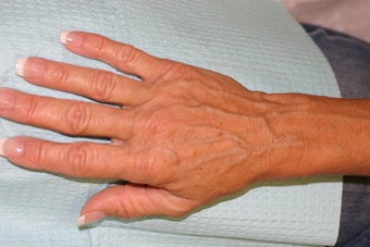 Sclerotherapy for hand veins