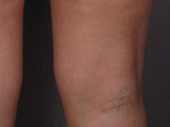 Sclerotherapy to Leg Veins