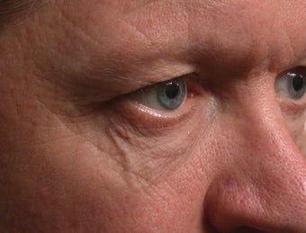 Sclerotherapy (eyelid)