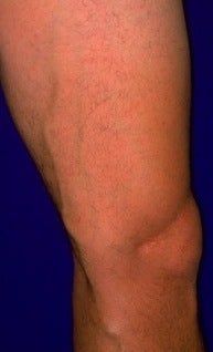 Sclerotherapy 