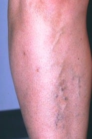 Sclerotherapy on Leg