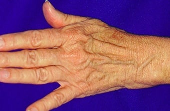 Sclerotherapy for hands