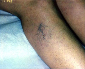 Sclerotherapy
