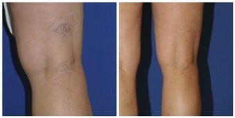 Sclerotherapy