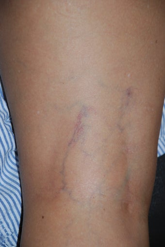 Sclerotherapy