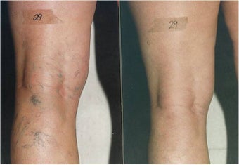 Vein Removal with Sclerotherapy