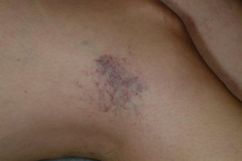 Sclerotherapy
