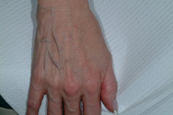 Sclreotherapy for the hands