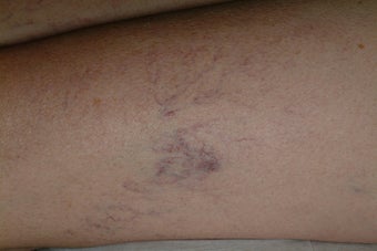 Sclerotherapy