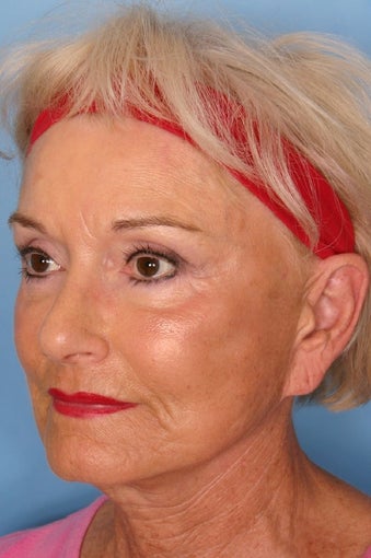 Sculptra Injections for Facial Volume Restoration 