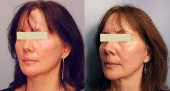 Sculptra treatments