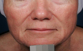 Fillers - Sculptra