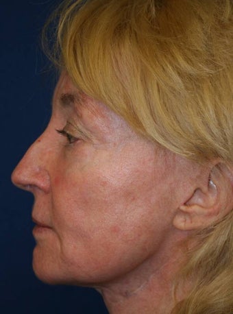 Sculptra Liquid Lift
