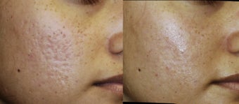 Acne scar