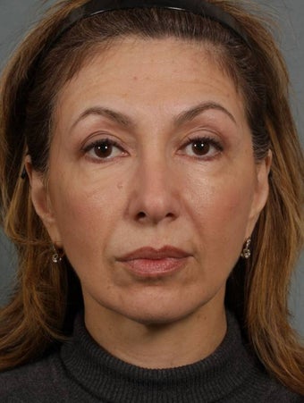 Sculptra 