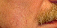 Sculptra