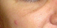 Sculptra