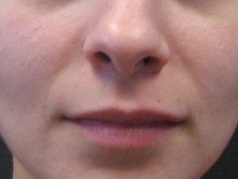 Sculptra injections