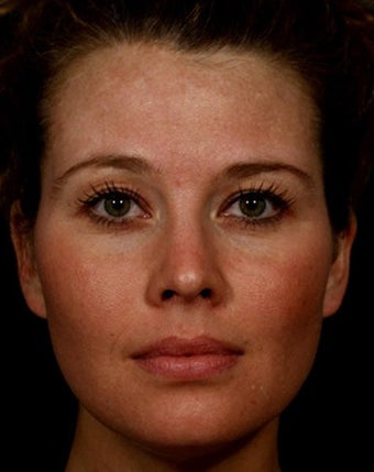 Sculptra
