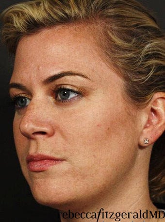 Sculptra /  IPL