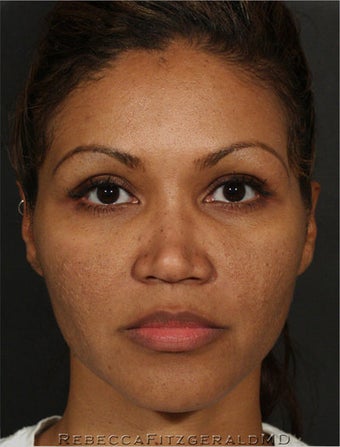 Sculptra & eMatrix
