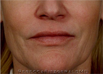 Sculptra, Botox, Juvederm and Restylane