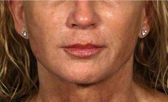 Sculptra, Juvederm, Obagi