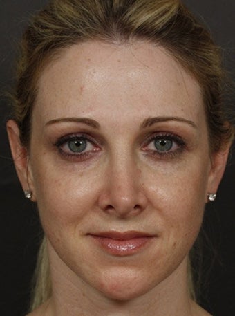 Sculptra