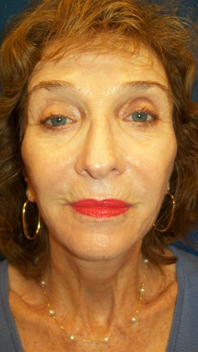 Sculptra