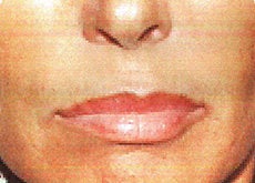 Sculptra
