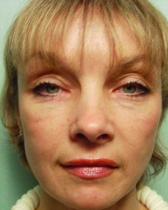 Liquid Facelift