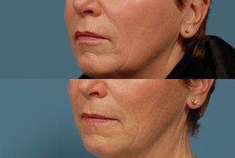 Sculptra  area around mouth