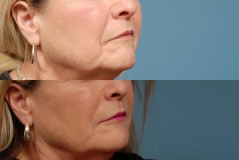 Sculptra