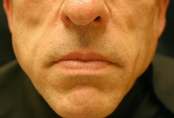 Sculptra