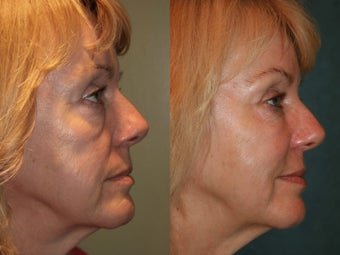 Sculptra