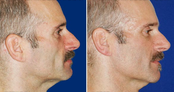 Sculptra